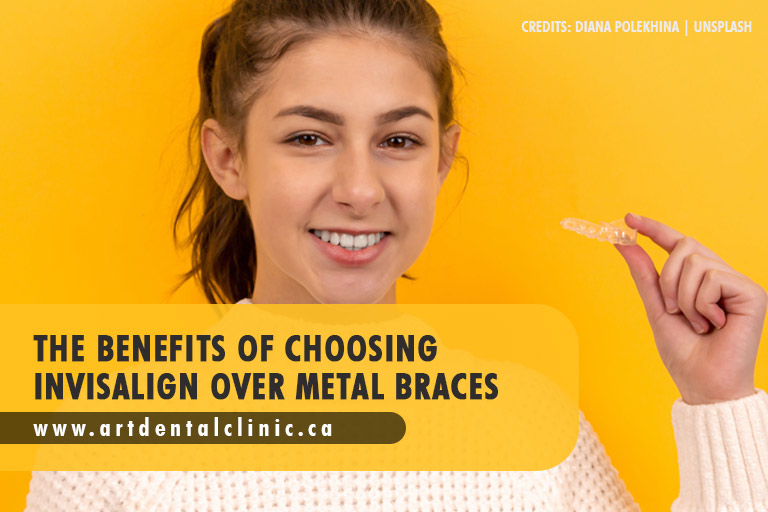 The Benefits of Choosing Invisalign Over Metal Braces https://unsplash.com/photos/pbAvxZzG8Ug
